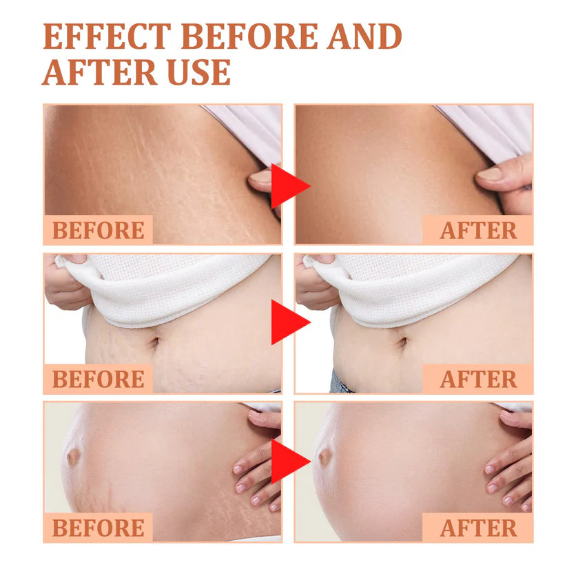Stretch Marks Removal Repair Cream
