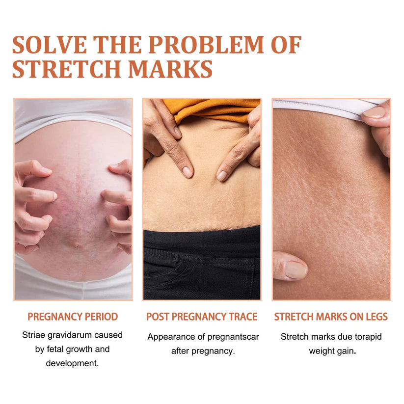 Stretch Marks Removal Repair Cream